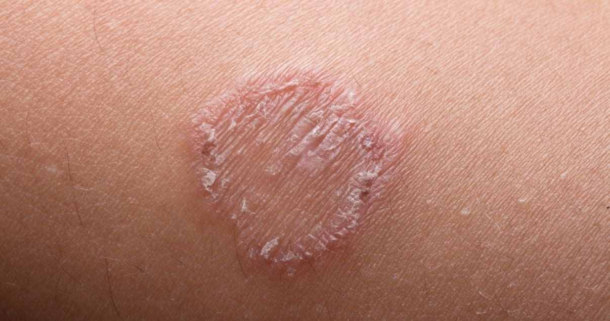 Is Ringworm Contagious?